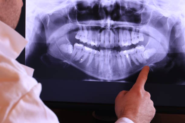 Best Emergency Wisdom Teeth Removal in Las Cruces, NM